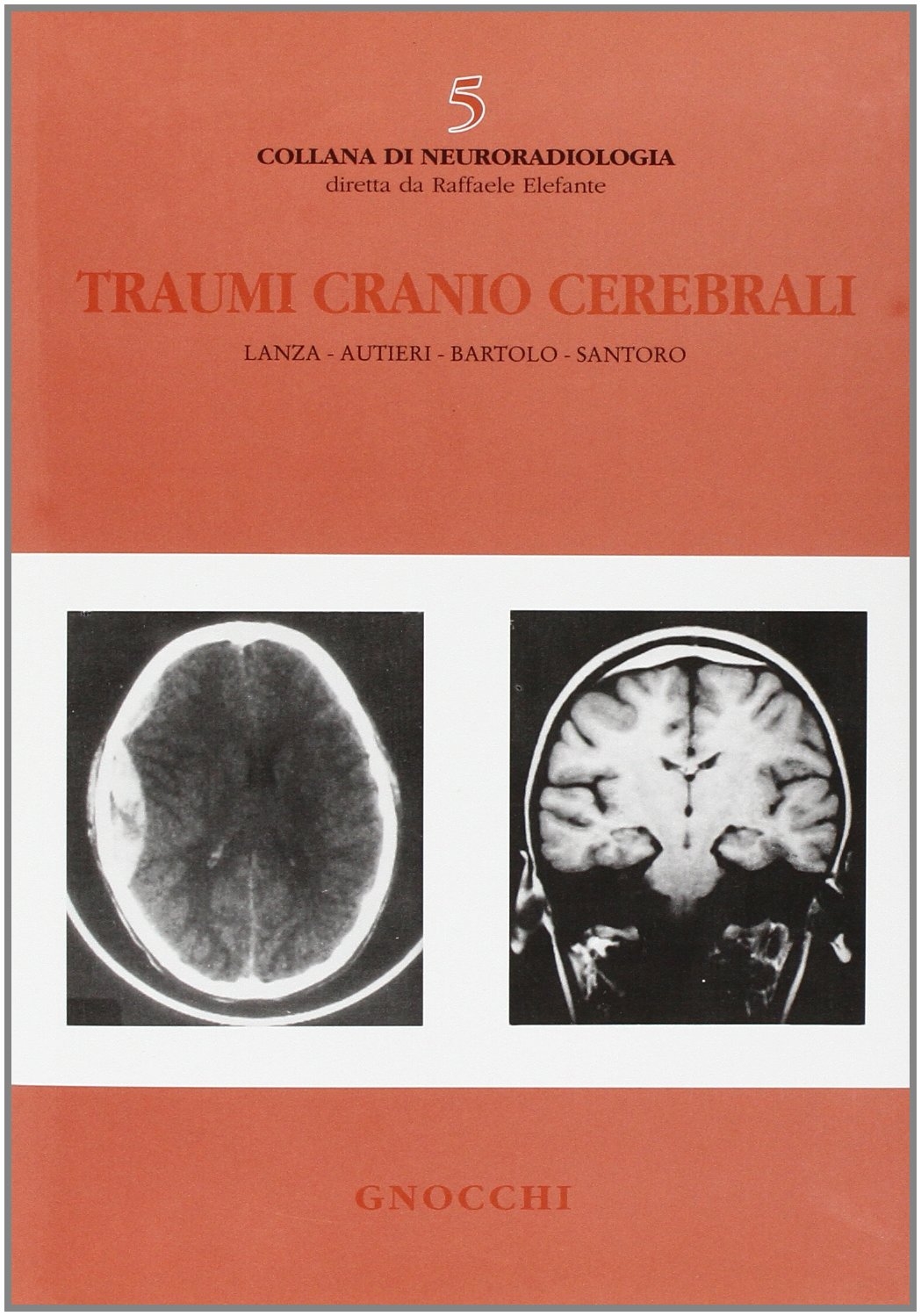 Traumi cranio cerebrali Traumi cranio cerebrali