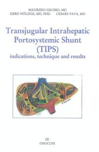 Transjugular intrahepatic portosystemic shunt (TIPS). Indications, technique and results