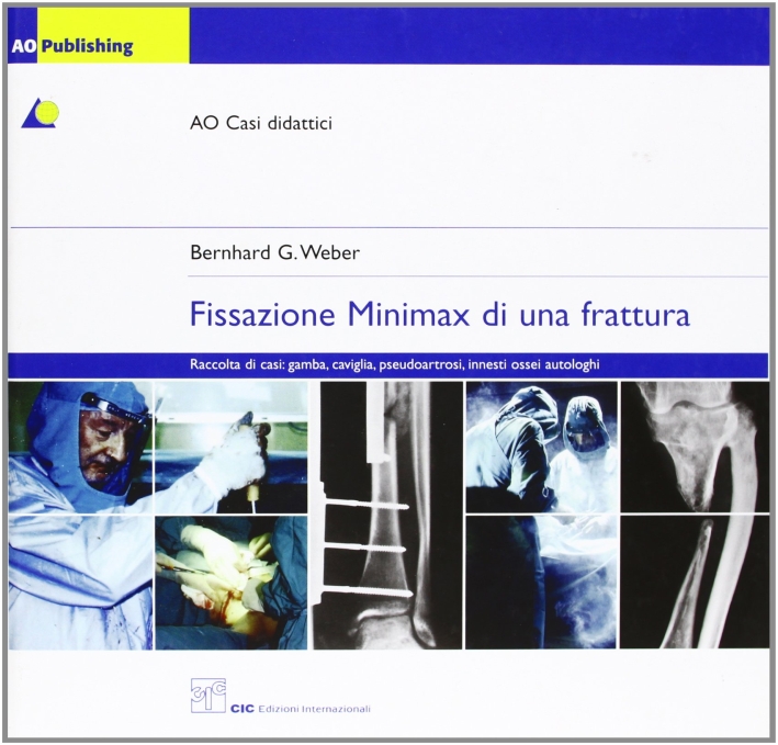 Fissazione minimax di una frattura Fissazione minimax di una frattura