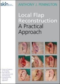 Local Flap Reconstruction