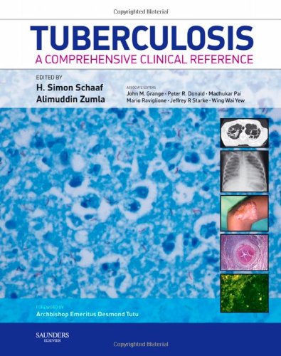 Tuberculosis Tuberculosis
