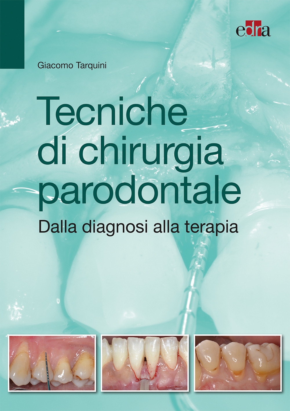 Tecniche di chirurgia parodontale. Dalla diagnosi alla terapia Tecniche di chirurgia parodontale. Dalla diagnosi alla terapia